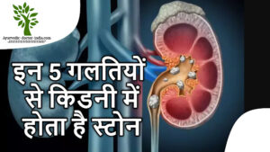 Kidney Stone ka aayurvedik upachaar