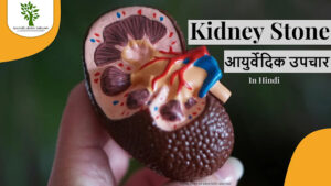 Kidney Stone ka aayurvedik upachaar